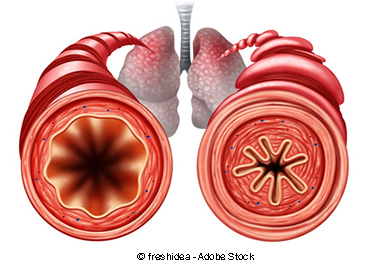 contraction of  bronchiolus in asthma (right)
