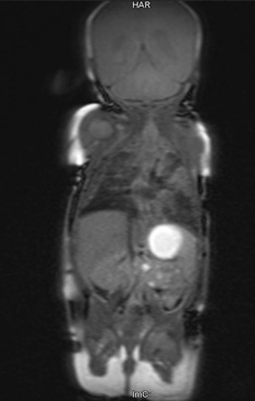 MRI image of a neonate