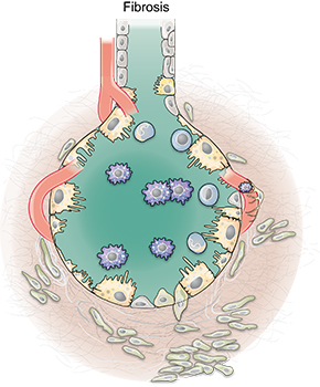 Grafische Illustration einer Lungenfibrose