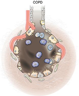 Graphic: Alveoli with COPD